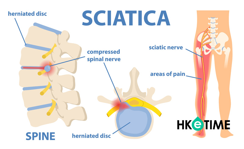 坐骨神經痛的病因